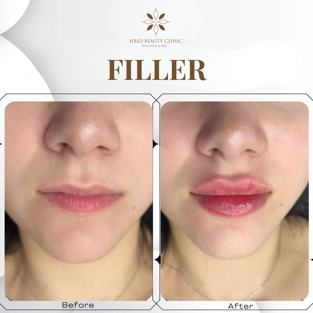 Các yếu tố ảnh hưởng đến giá tiêm filler môi