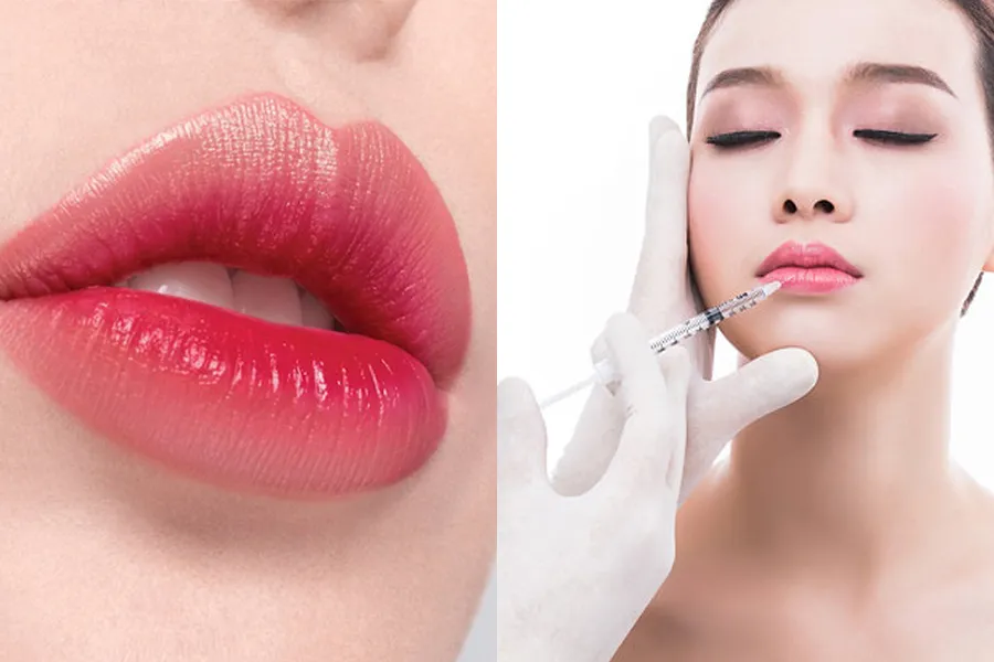Bảng giá tiêm filler môi 2025