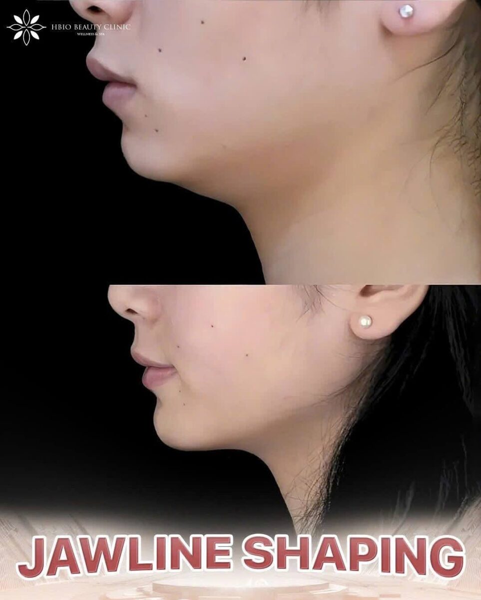 chi phí tiêm filler cằm