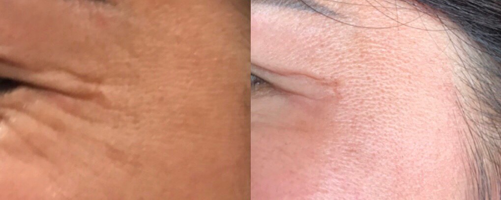 Effective wrinkle reduction