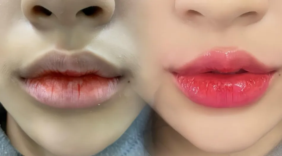 Cost of botox lip wrinkle removal at HBio Clinic
