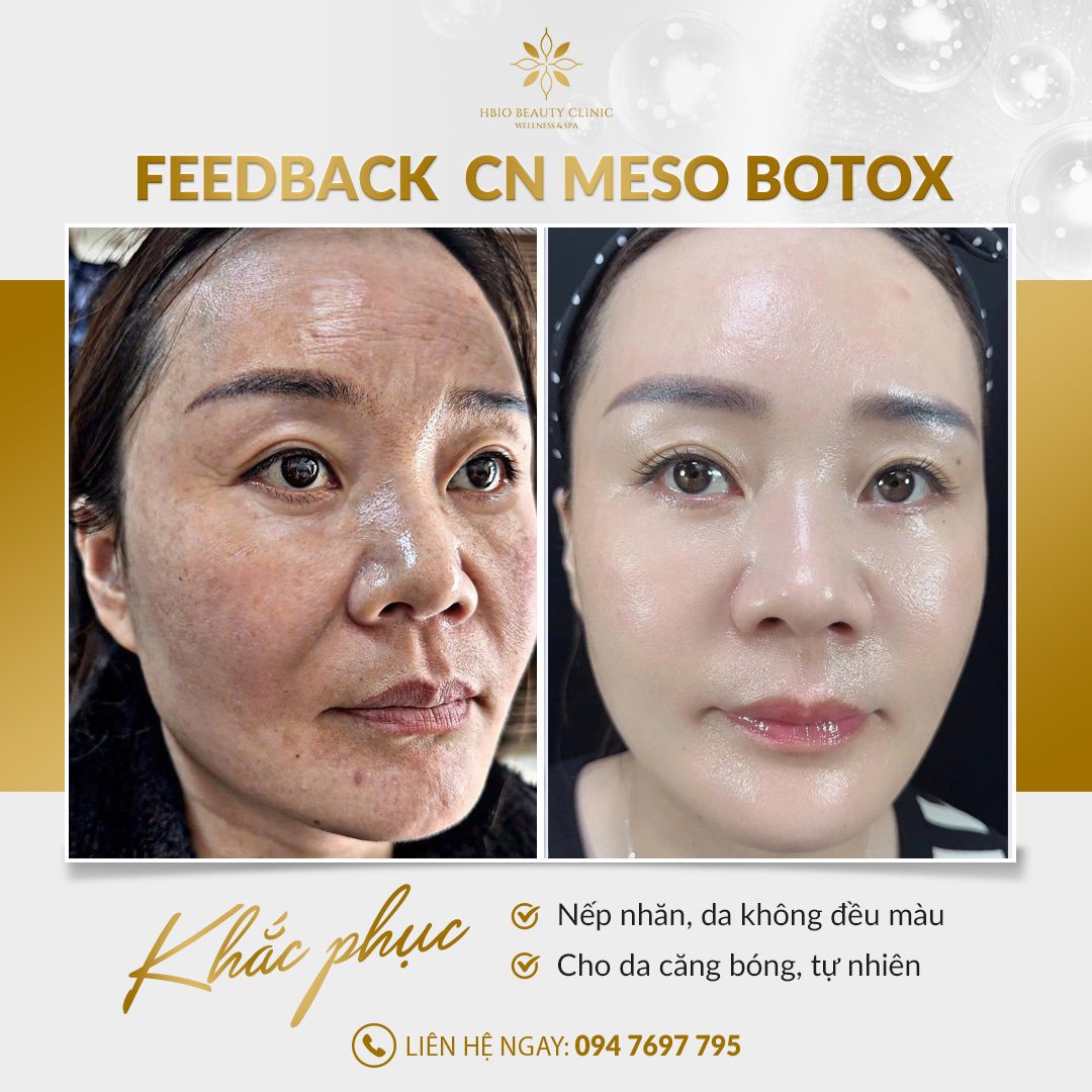Khách hàng trước và sau khi tiêm meso