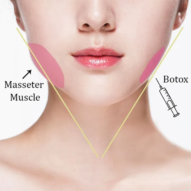 Khi nào nên lựa chọn tiêm gọn hàm?