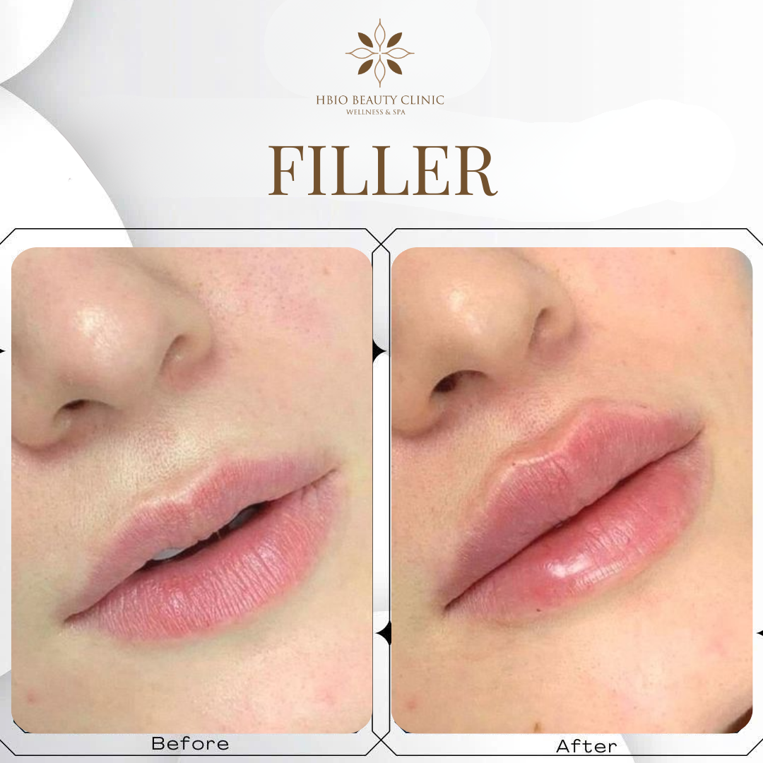 Lợi ích của tiêm filler môi