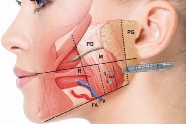 Tiêm Botox gọn hàm có được vĩnh viễn không?