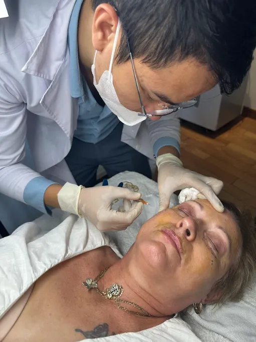 Tiêm filler vào vùng rãnh lệ
