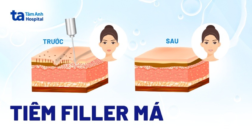 Tiêm má là gì?