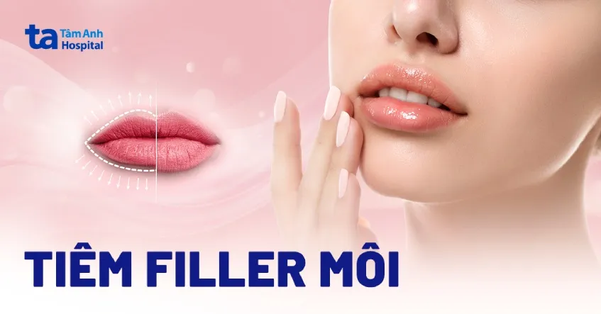 Tìm hiểu tổng quan về tiêm filler môi