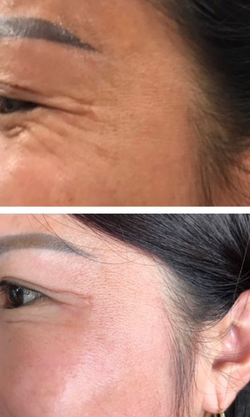 trước và sau khi tiêm filler xóa rãnh lệ