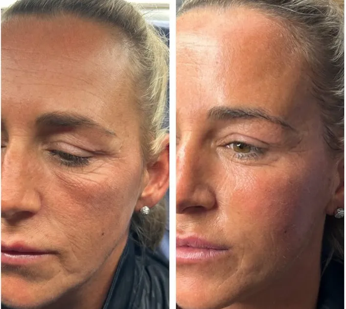 trước và sau khi tiêm filler xóa rãnh lệ
