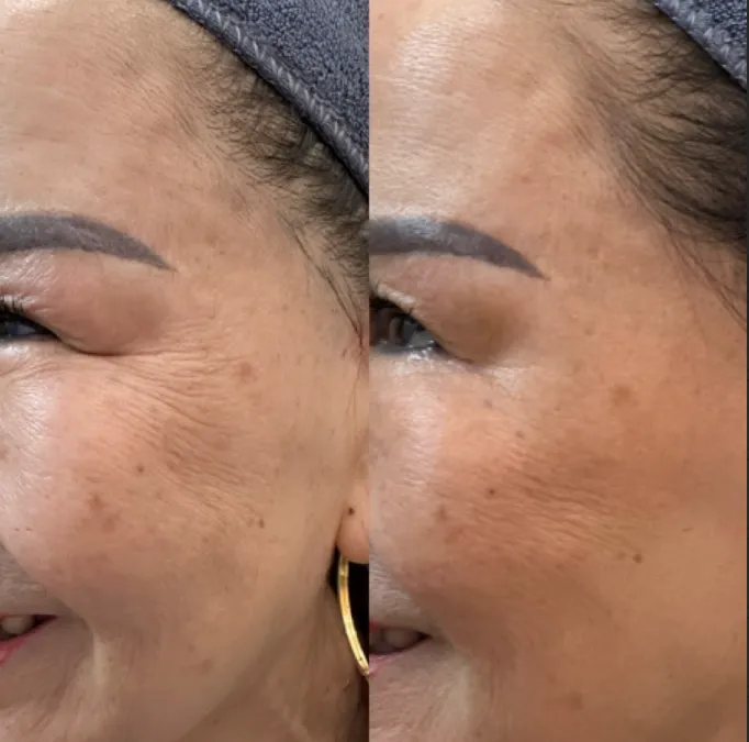 trước và sau khi tiêm filler xóa rãnh lệ