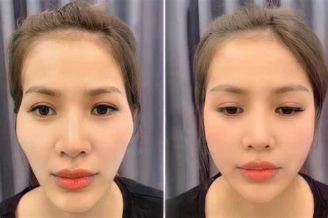 Ưu điểm của tiêm rãnh cười