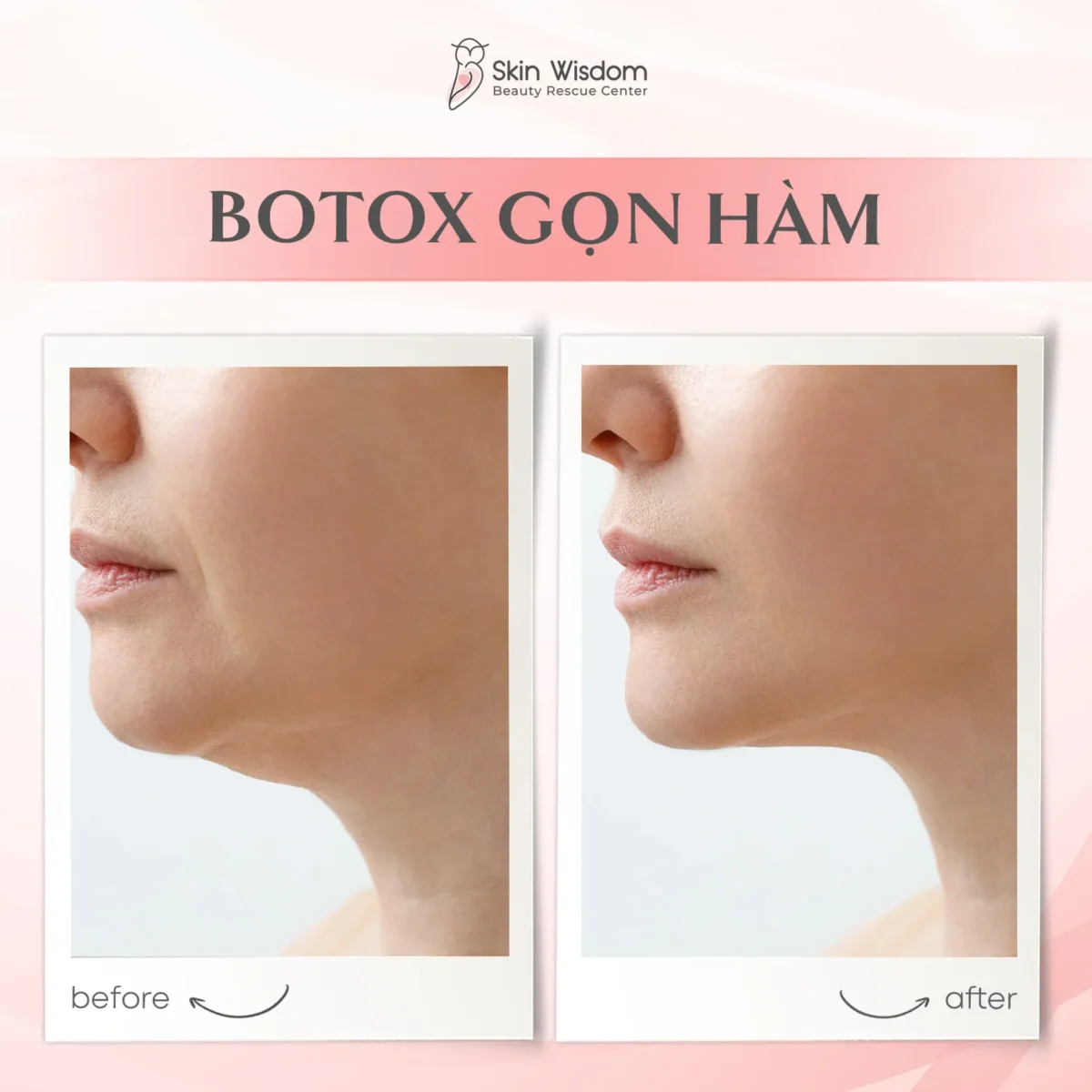 Ưu điểm vượt trội botox tiêm gọn hàm