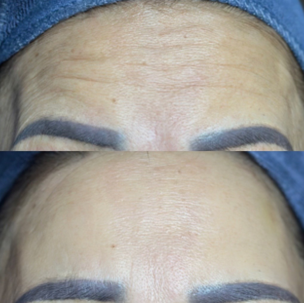 Outstanding benefits of botox for forehead wrinkles