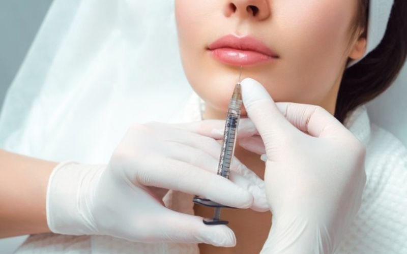 Xóa Nhăn Môi Bằng Botox