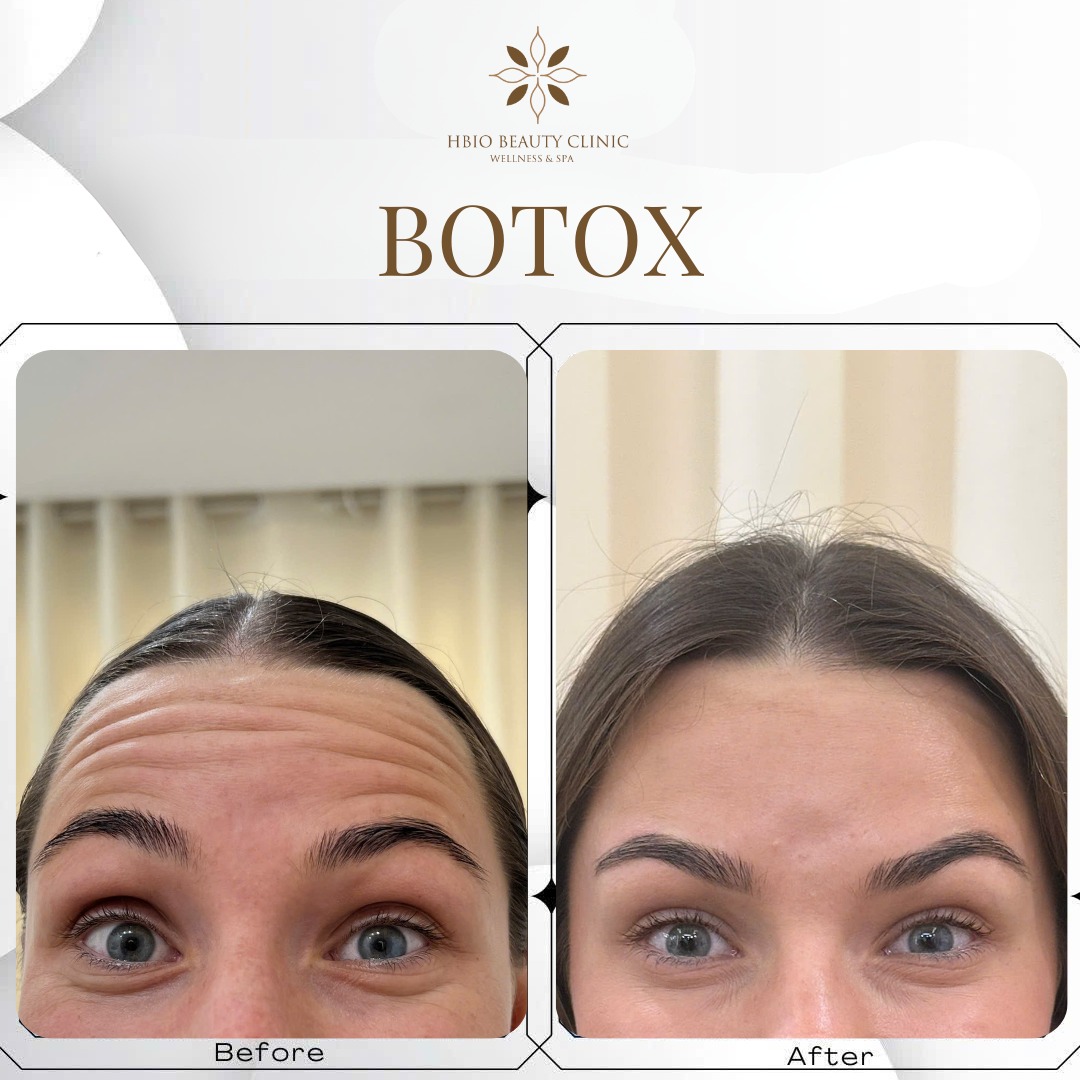 Ưu điểm vượt trội tiêm botox xóa nhăn trán