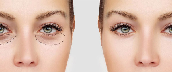 Xóa rãnh lệ là gì?