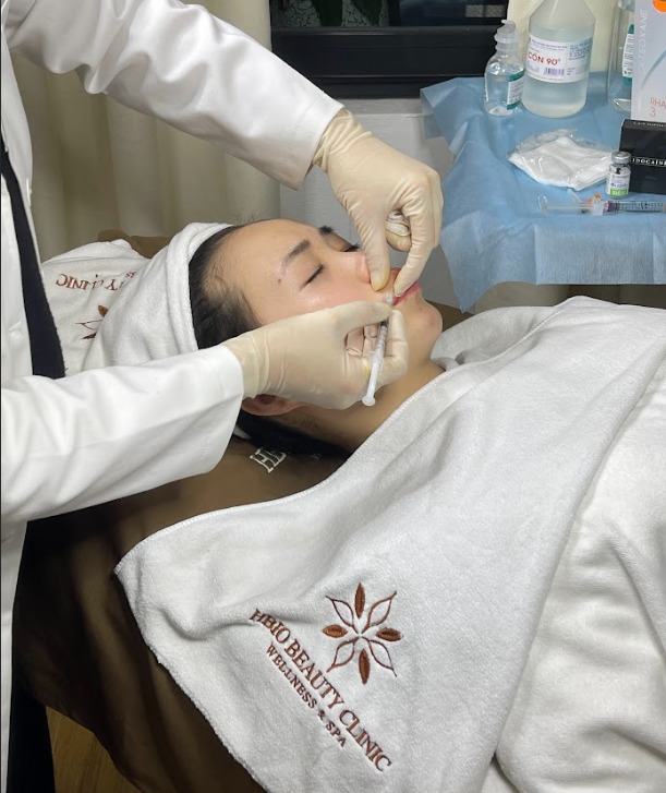 Các loại filler được bộ y tế cấp phép