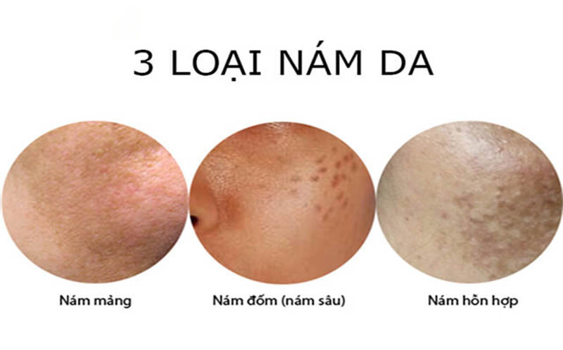 Các loại nám da phổ biến