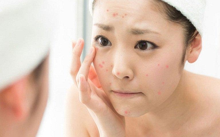Các nguyên nhân gây ra mụn mà bạn cần chú ý 