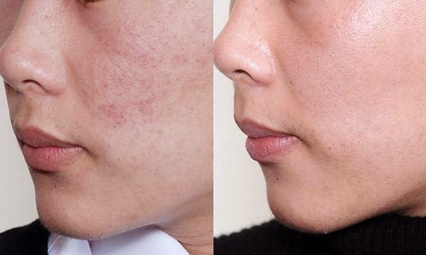 Cải thiện sẹo mụn lâu năm