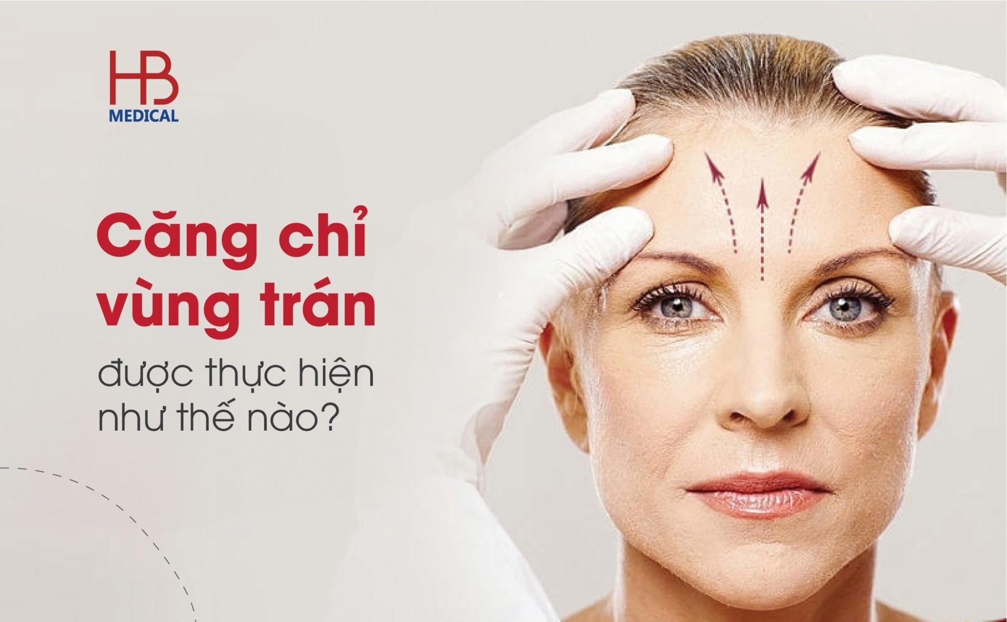 Căng chỉ trán là gì?
