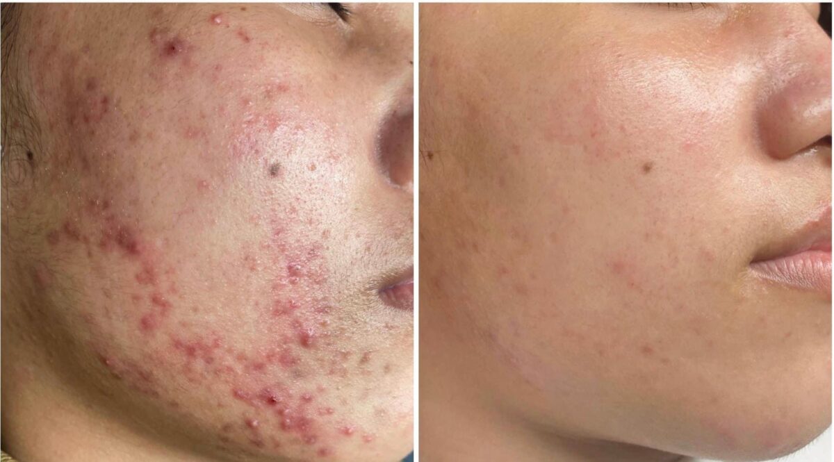 Chăm sóc da bằng phương pháp deep cleansing
