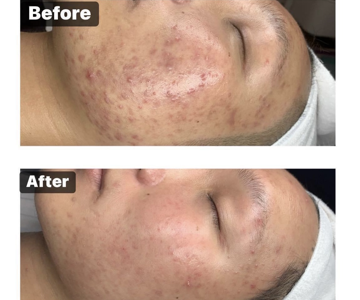 Chăm sóc da bằng phương pháp deep cleansing 1