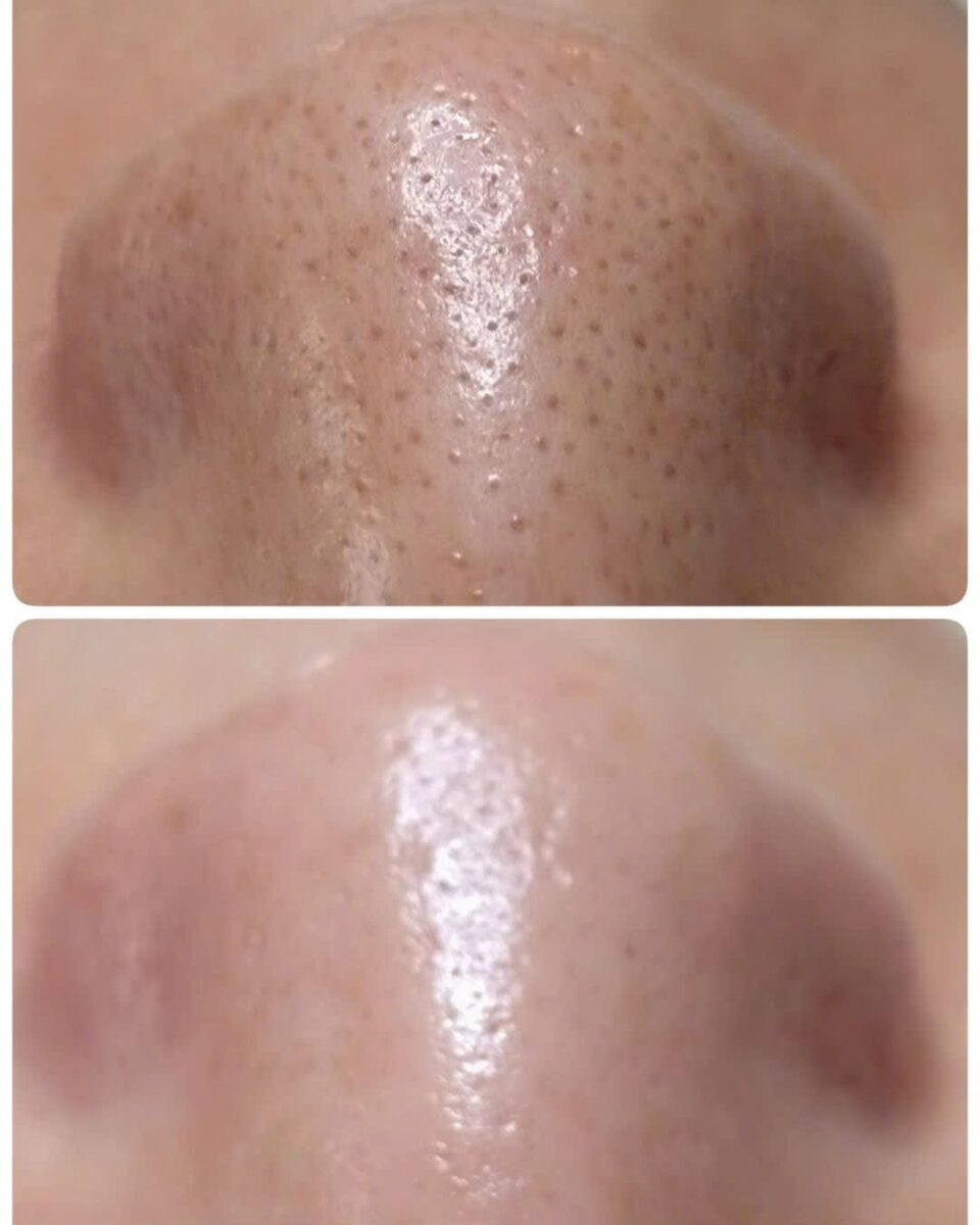 Chăm sóc da Oxyjet hỗ trợ thu nhỏ lỗ chân lông