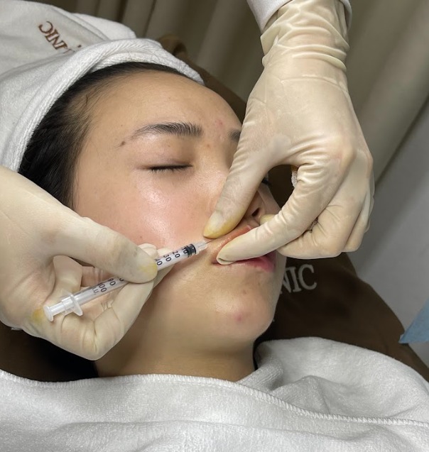 Có nên tiêm filler? Tiêm filler có an toàn không?