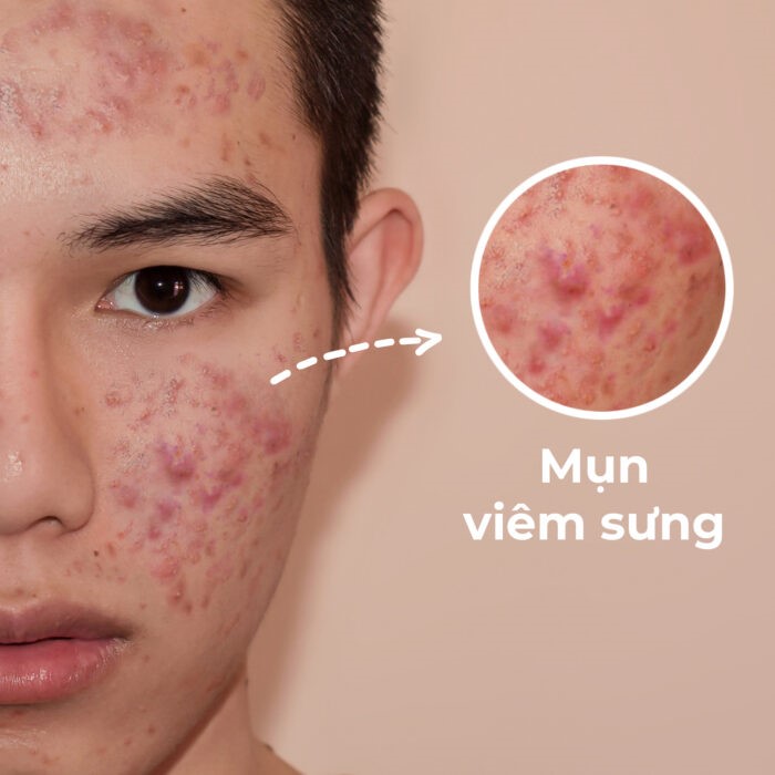 Có nhiều nguyên nhân khiến làn da bị mụn viêm