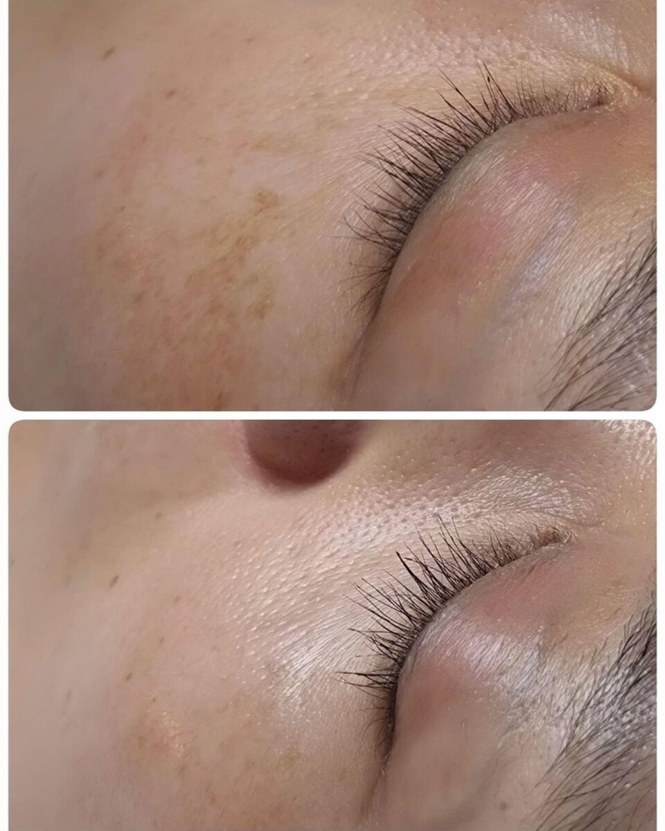 Công nghệ needle RF giúp làm sáng và đồng đều màu da