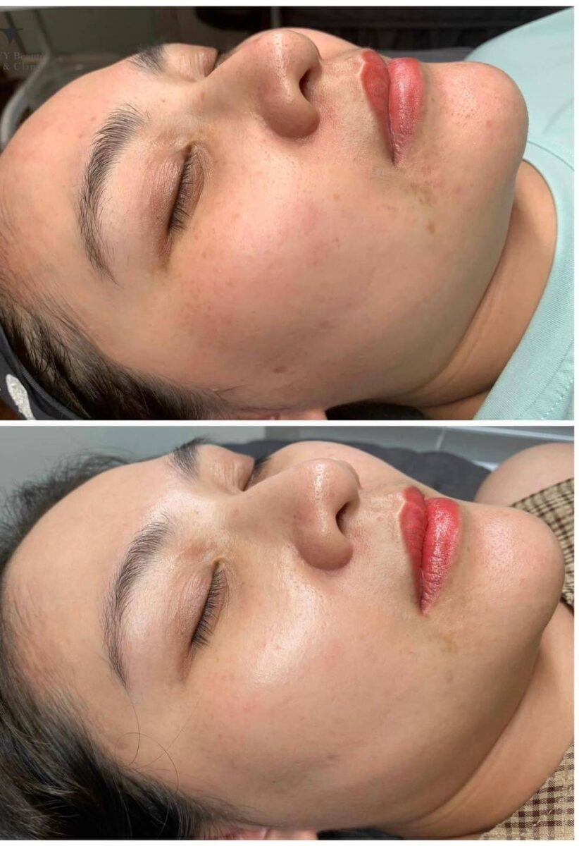 Công nghệ Plasma giúp cải thiện tình trạng tăng sắc tố da