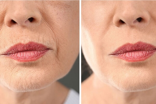 Dấu hiệu của làn da chảy xệ 