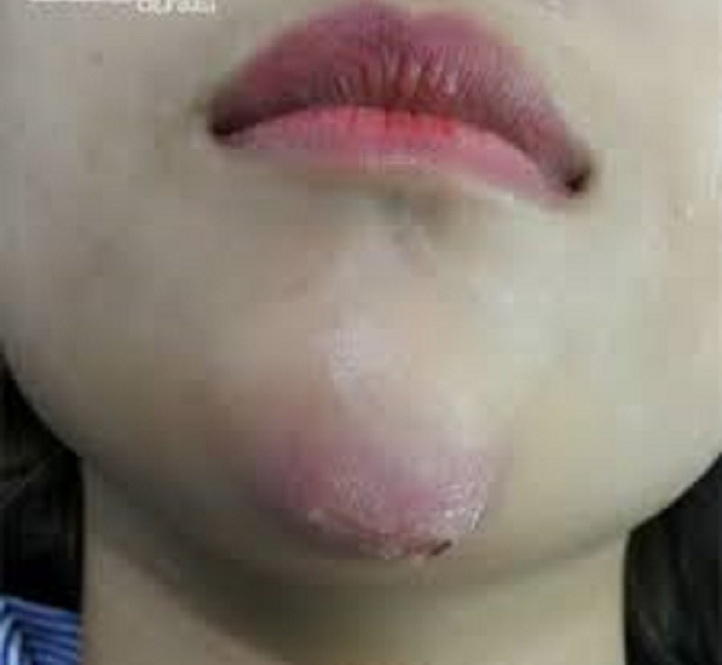 Dấu hiệu nhận biết tiêm filler bị vón cục theo vùng cằm