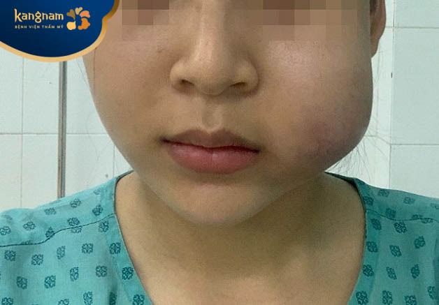 Dấu hiệu nhận biết tiêm filler bị vón cục theo vùng cằm