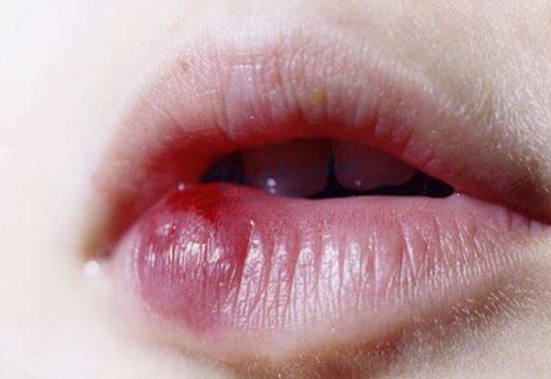 Dấu hiệu nhận biết tiêm filler bị vón cục theo vùng môi