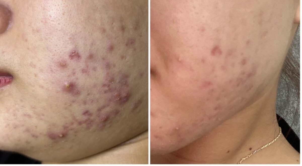 Deep Cleansing phù hợp với vấn đề da