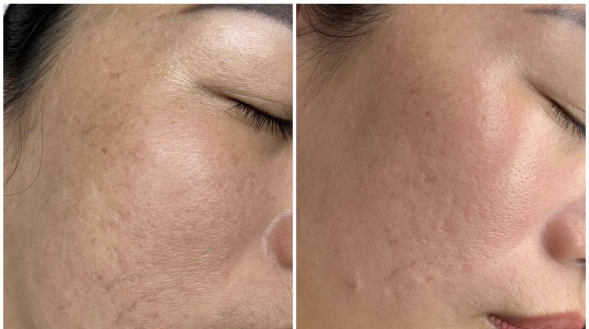Khách hàng điều trị sẹo bằng meso tại HBIO Clinic