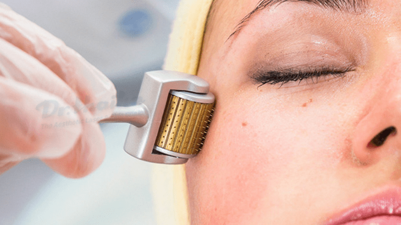 Microneedling for dark spots