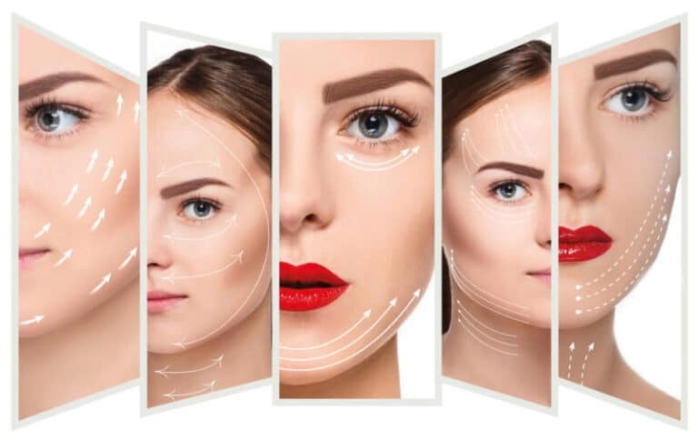 Đối tượng nên căng chỉ má