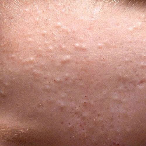 Hình ảnh mụn ẩn li ti trên trán