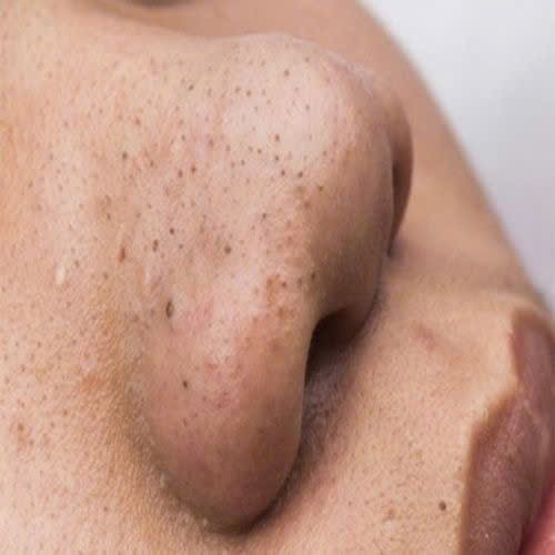 Hình ảnh mụn đầu đen trên mũi