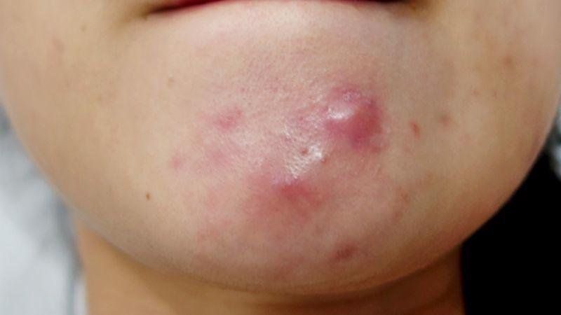 Hình ảnh mụn nang phát triển dưới cằm