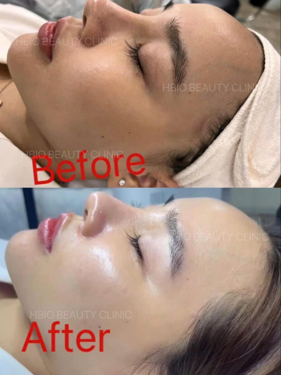 Hình ảnh trước – sau khi thực hiện Face Guisa