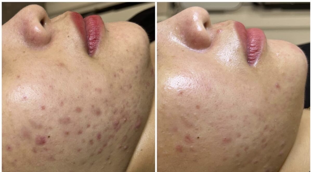 Hình ảnh trước và sau khi điều trị bằng công nghệ aqua peel