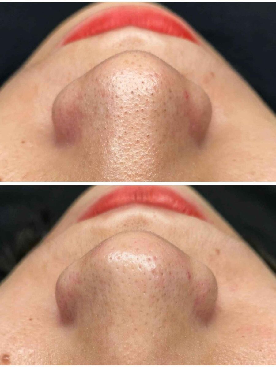 Hình ảnh trước và sau khi điều trị bằng công nghệ aqua peel