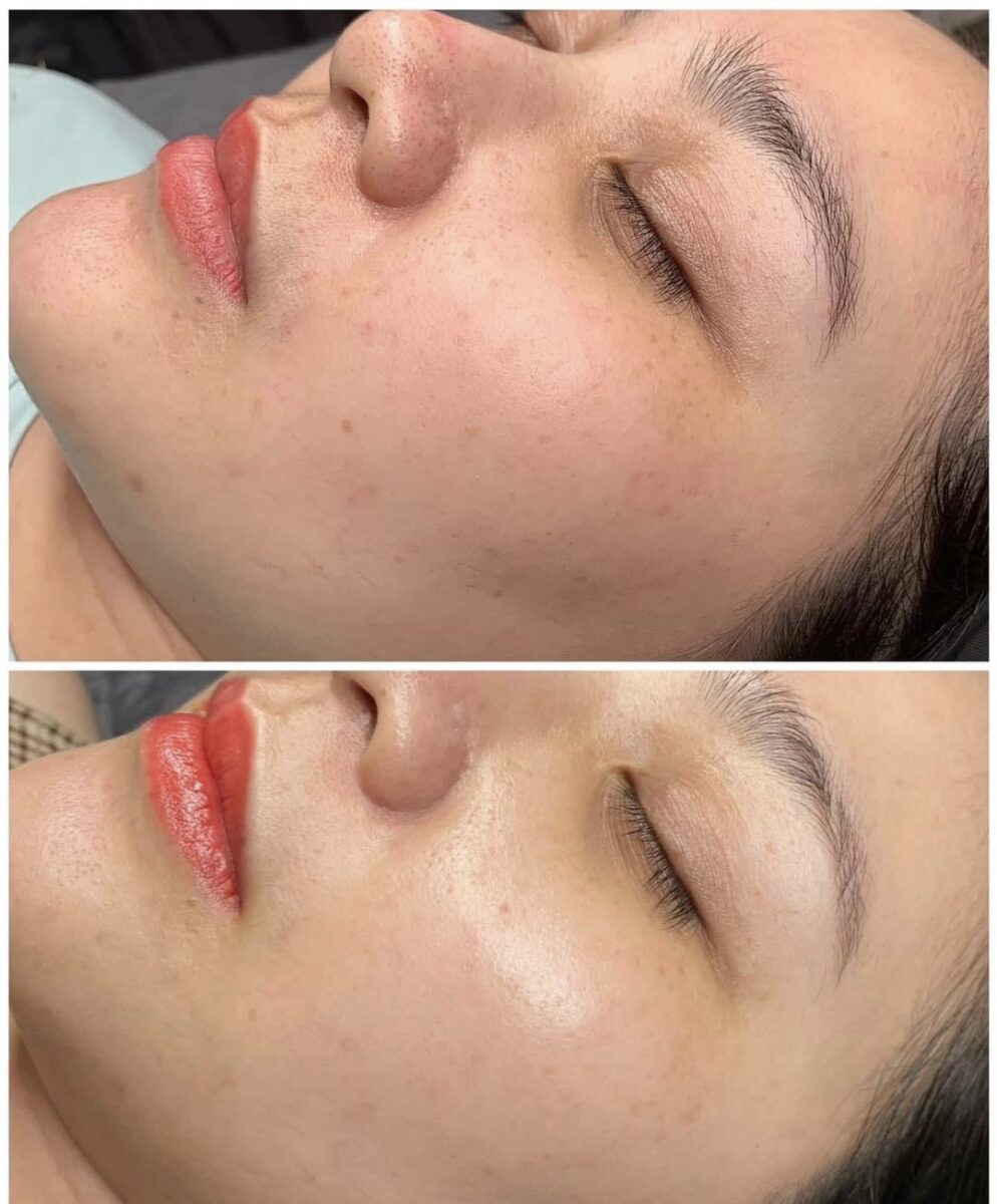 Hình ảnh trước và sau khi điều trị bằng công nghệ aqua peel