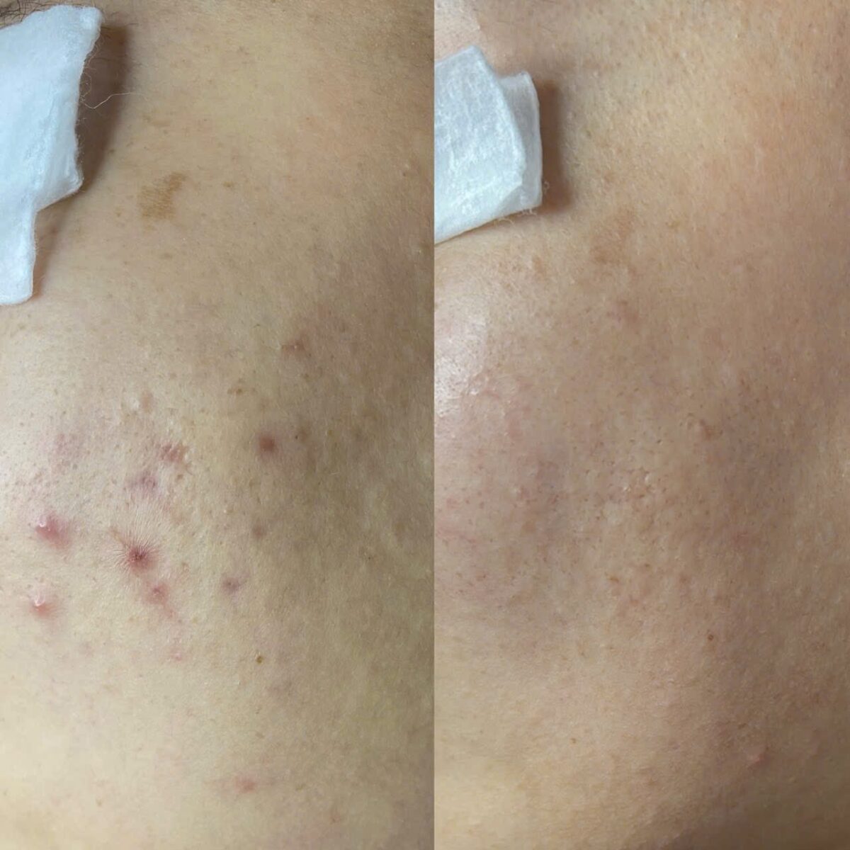 Post-Treatment skincare guidelines