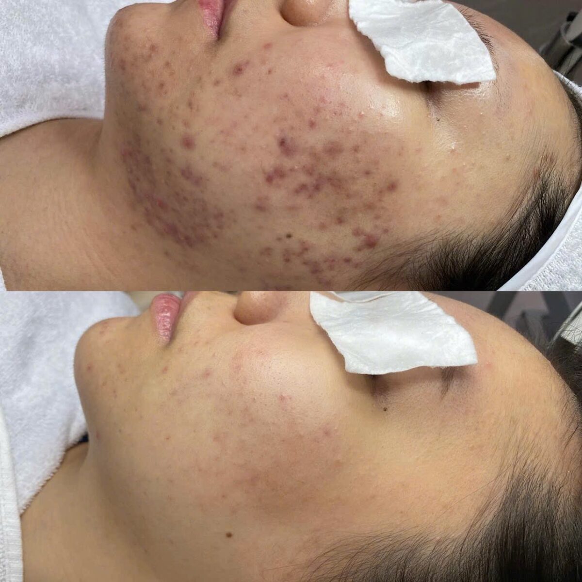 Hydrafacial (Chăm Sóc Da HydraFacial)